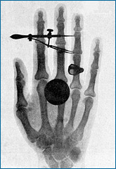 Um raio-X da mão da esposa de Wilhelm Roentgen