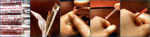 Procedimento de acupunctura